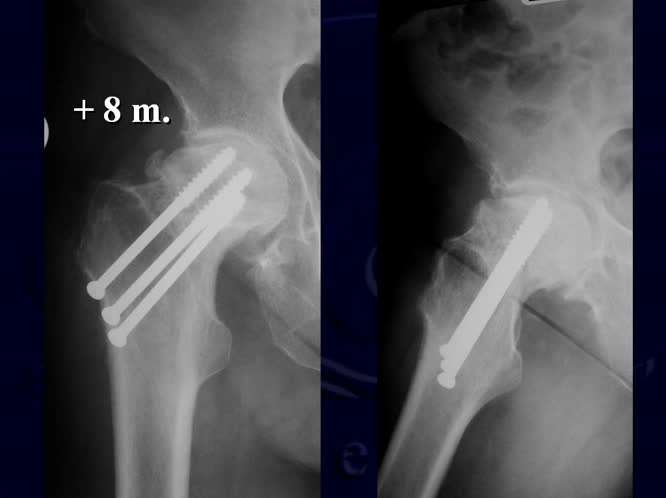 Lo stelo lateralizzante