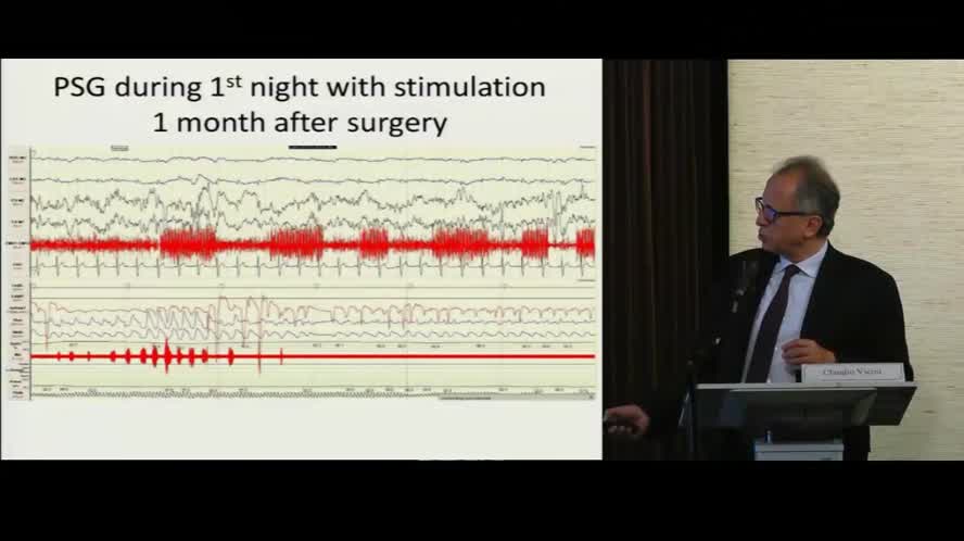 Neurostimolazione dell’ipoglosso