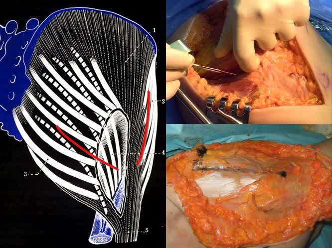 Accesso mini-invasivo postero-laterale conservativo