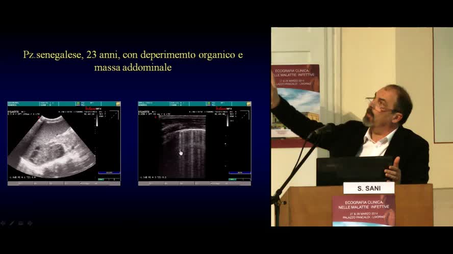 Ecografia nella tubercolosi