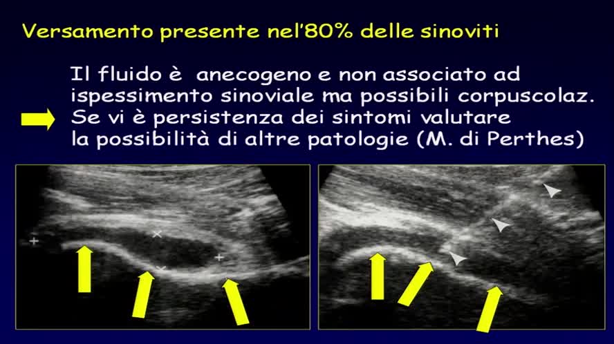 Ecografia nelle infezioni osteoarticolari