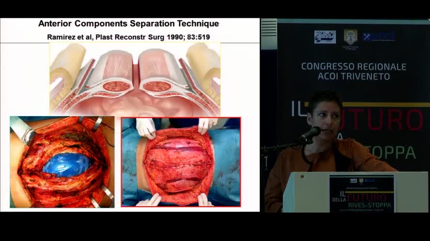 Component Separation for the Closure of Open Abdomen in Trauma