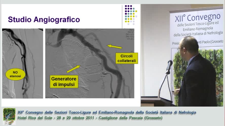 Stenosi della vena cava superiore in un paziente in emodialisi cronica, non dovuta a catetere venoso centrale