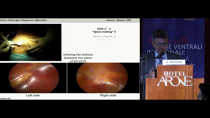 Separazione dei componenti anteriore endoscopica