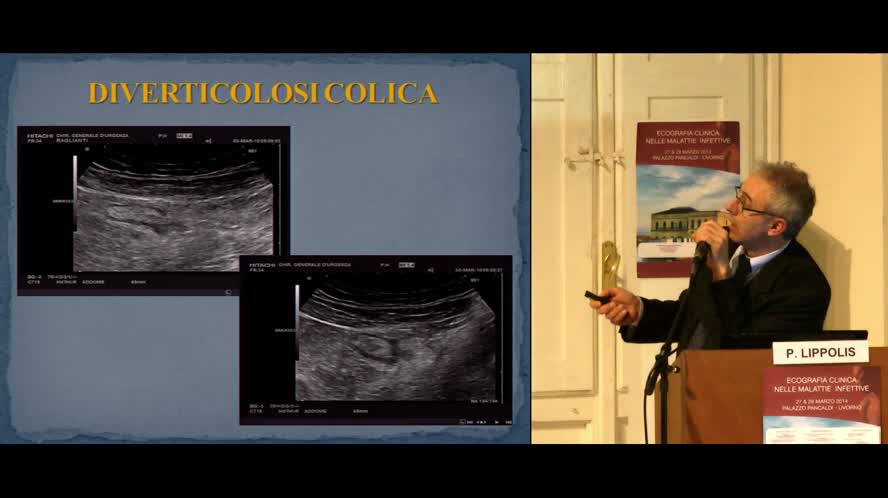 Patologia intestinale enterite appendicite e diverticolite