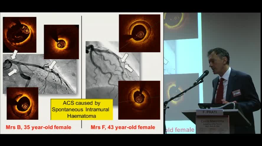 Identificazione della placca coronarica instabile