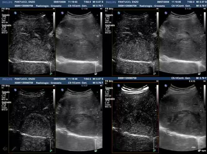 13 - Epatocarcinoma Caso Clinico