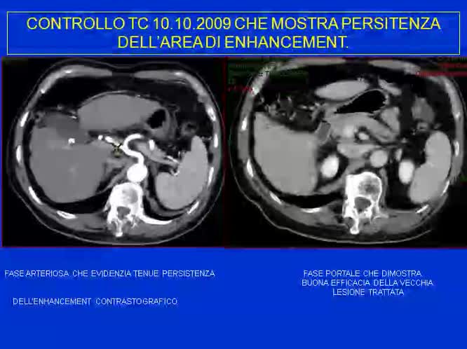 15 - Caso clinico HCC