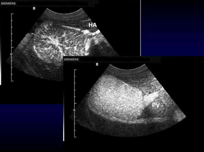 Adenoma epatocellulare