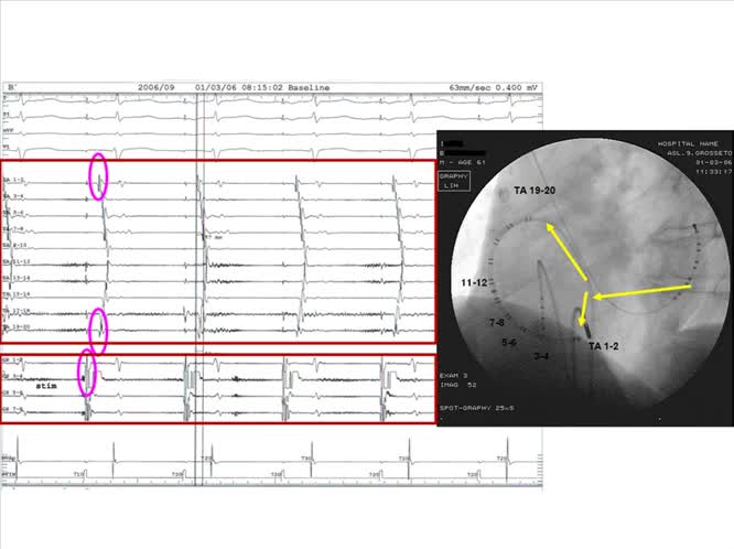 Ablazione del Flutter Atriale Validazione del Risultato