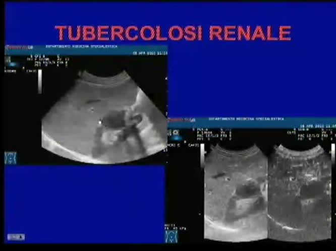 Tubercolosi linfonodale