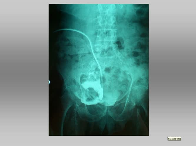 Ruolo della dialisi peritoneale