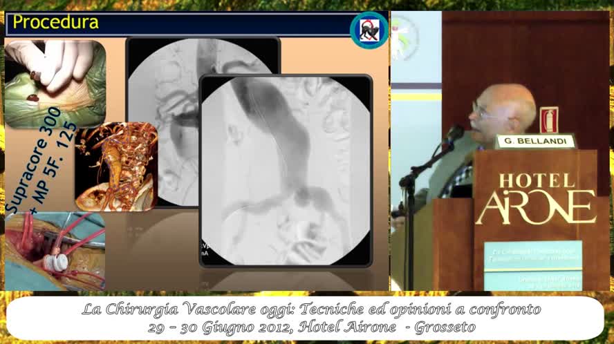 EVAR AAA nei pazienti con colletto ostile