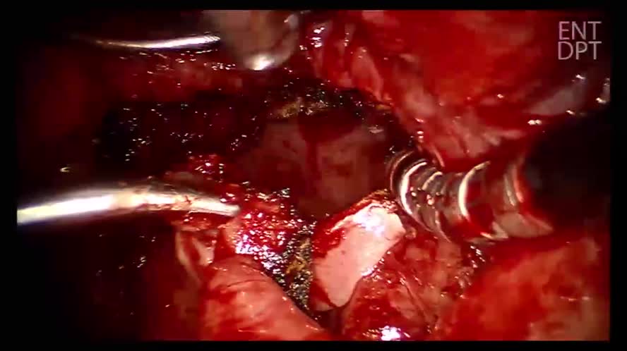 Chirurgia Robotica TORS