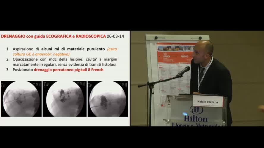 C'è ascesso epatico e ascesso epatico