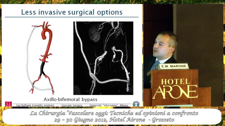 Il miglior trattamento delle occlusioni aortiche juxtarenali 