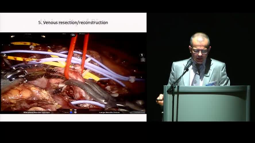 Minimally invasive pancreatoduodenectomy: robotic vs laparoscopic approach