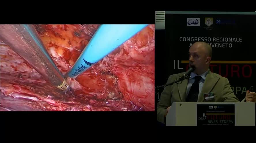 Rives-Stoppa con separazione anteriore dei componenti con tossina botulinica