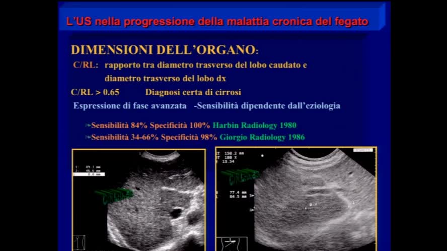 Dall'epatite cronica alla cirrosi
