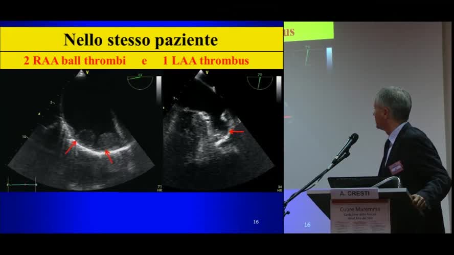 Frequenze e significato della Trombosi dell'auricola destra