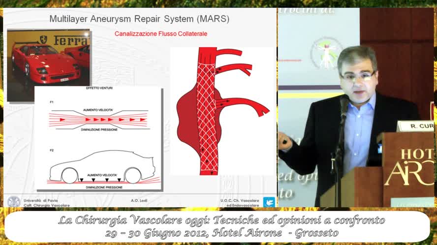 Lo stent multilayer nel trattamento degli aneurismi del tratto femoropopliteo
