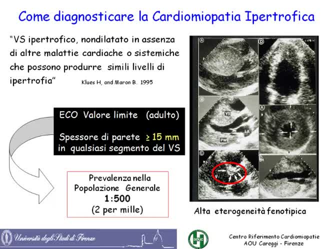 Miocardiopatia ipertrofica e sport