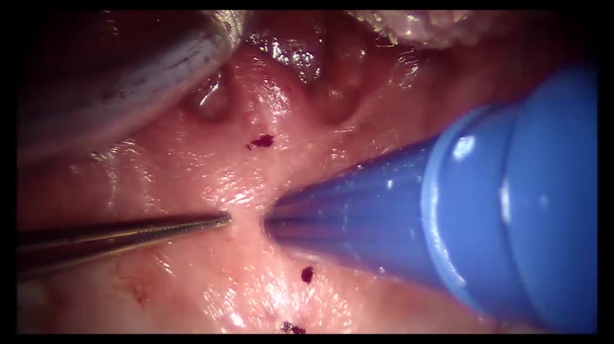 Palatoplastica anteriore