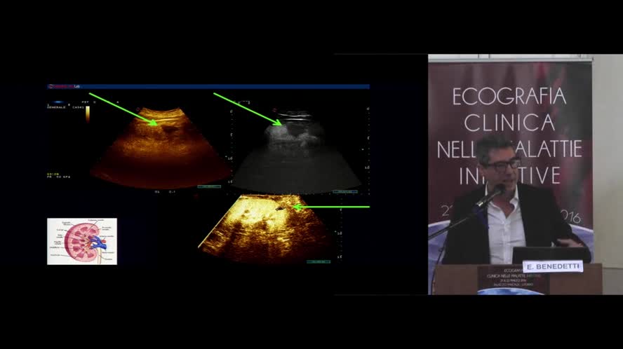Milza e linfonodi: Il paziente ematologico