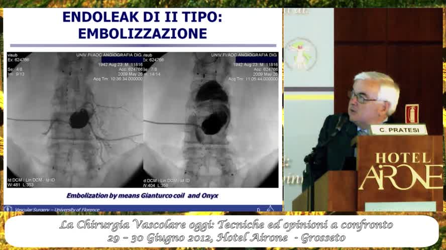 Gli endoleak di II tipo: quando e come trattarli