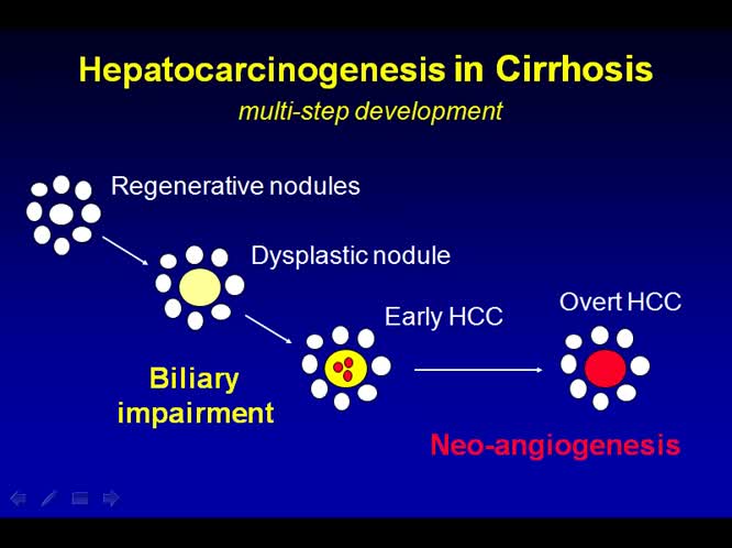 02 - Epatocarcinoma Imaging diagnostico
