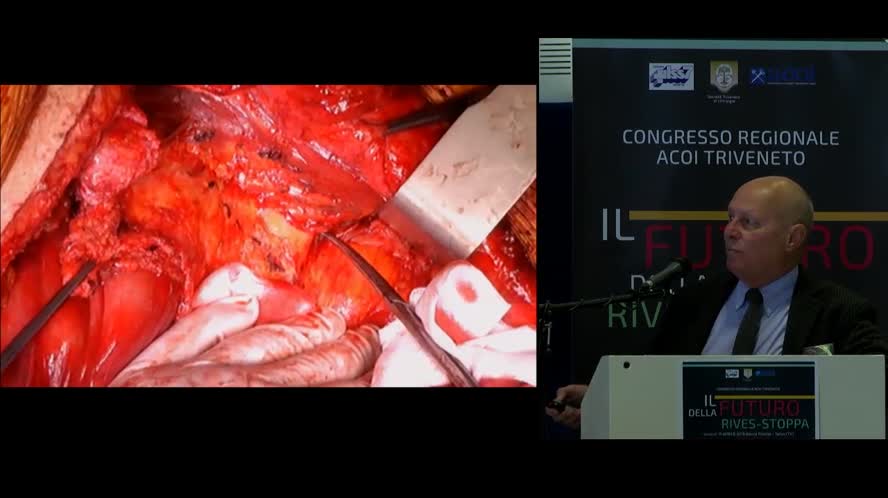 Posterior Component Separation Trans Abdominis release TPS TAR How i do it