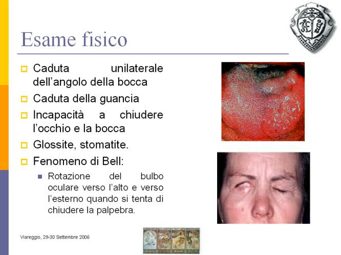 Paralisi del faciale "a frigore"