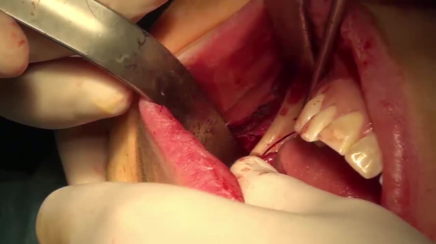 Distrazione mandibolare