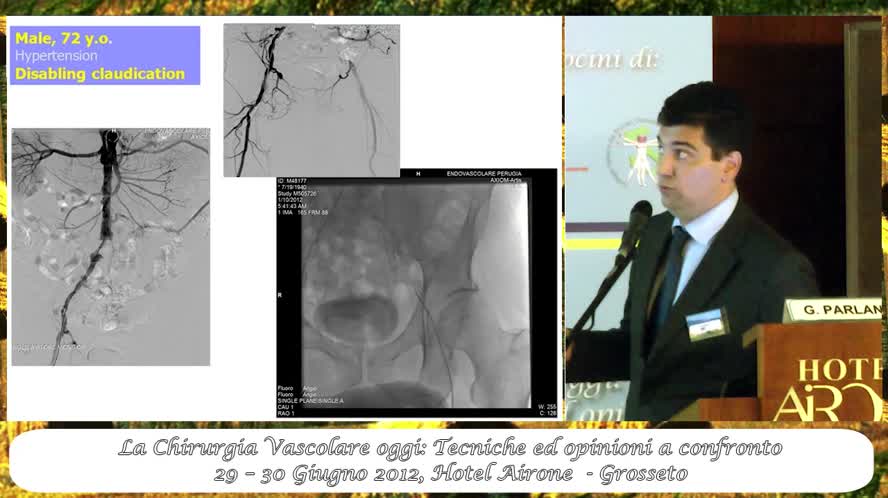 Trucchi del mestiere nel trattamento delle occlusioni complete del distretto aortoiliaco