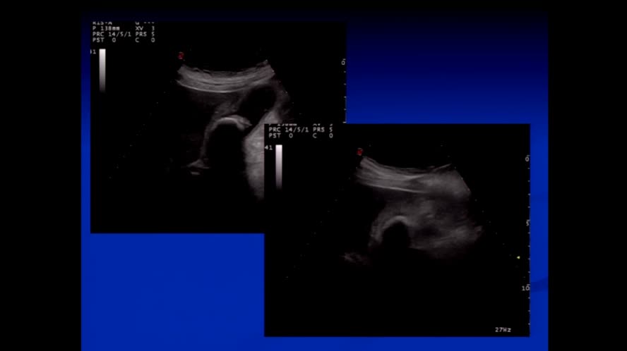Patologia infettiva della colecisti e delle VB