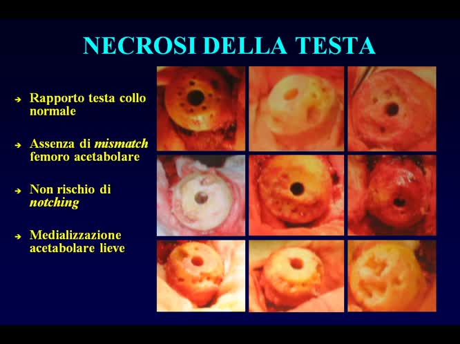 La protesi di rivestimento