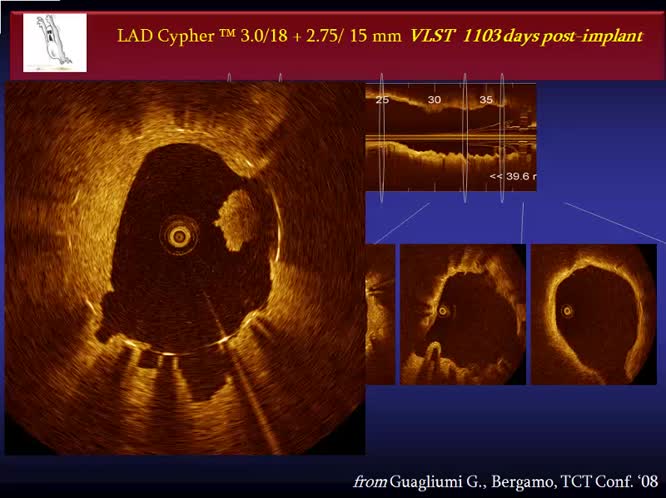 Dove l imaging con OCT influenza le decisioni terapeutiche