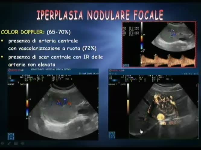 Iperplasia focale nodulare