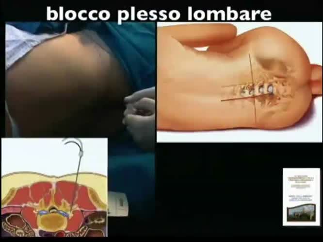 Anestesia locoregionale nelle protesi di anca e ginocchio e nuovi anticoagulanti orali l esperienza dell anestesista