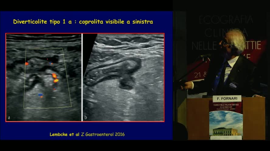 Patologia intestinale: enteriti, appendicite e diverticolite