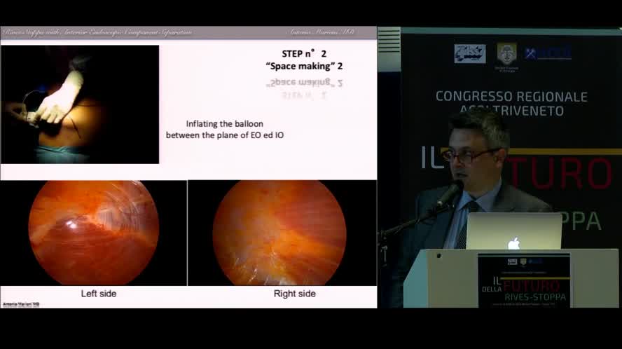 Rives-Stoppa con separazione anteriore dei componenti laparoscopica