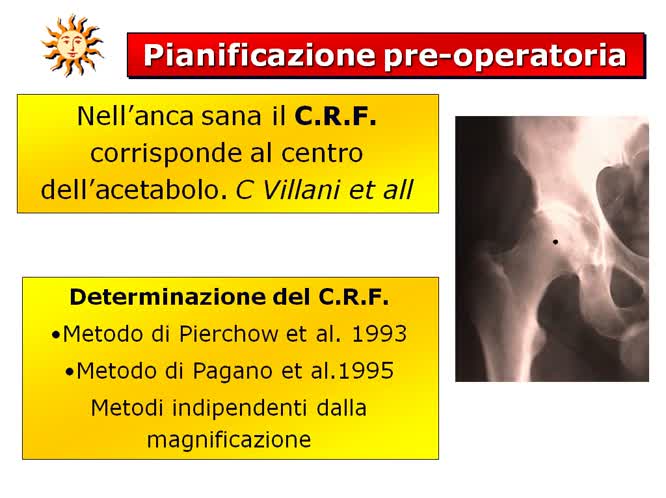 Importanza dell offset protesico nella geometria articolare