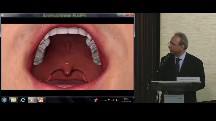 Barbed Anterior Pharyngoplasty - BAPh