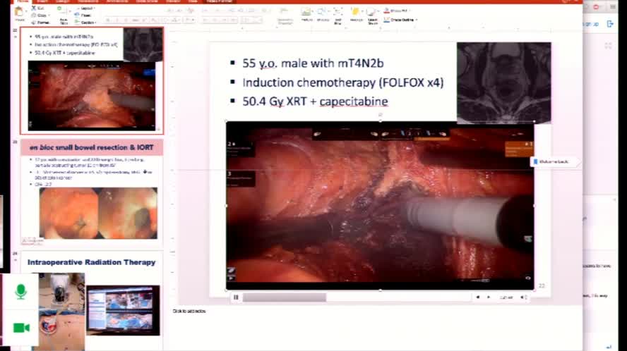 Video Conference from Houston, USA Robotic surgery in locally advanced rectal cancer