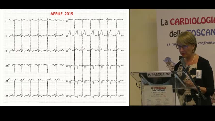 L'ECG dello sportivo: Varianti normali o patologiche una diagnosi non sempre facile