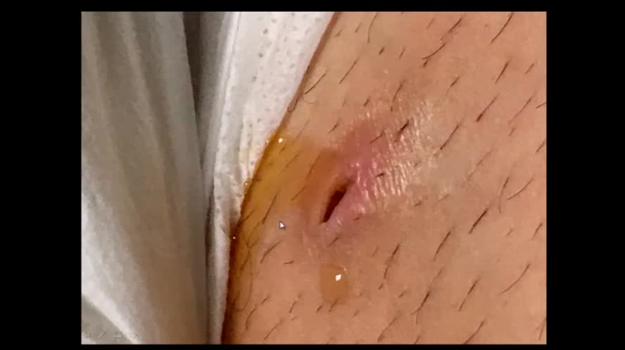 Ecografia in urgenza nel paziente con sepsi: L'infettivologo