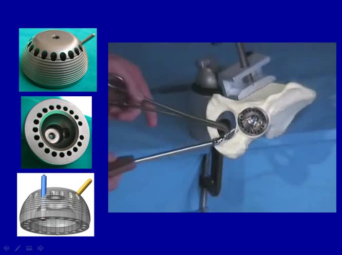 Il corretto posizionamento del cotile