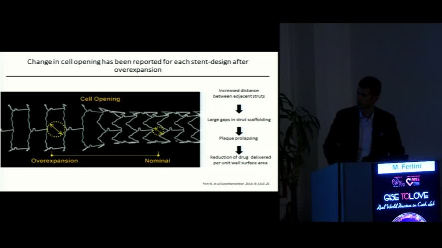 Stent Onix in large vessel
