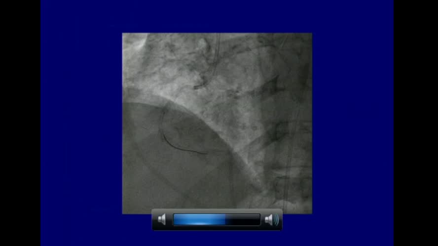 Due lesioni per uno stemi Angioplastica primaria differita When is late too late