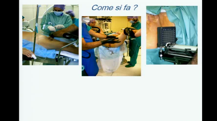 La brachiterapia: a chi e come